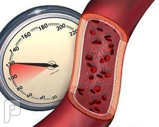 ماهو ارتفاع ضغط الدم ؟وماهى أسبابه؟ وعلاجه ؟