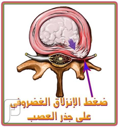 الانزلاق الغضروفي