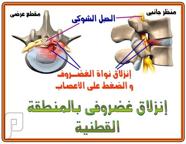الانزلاق الغضروفي