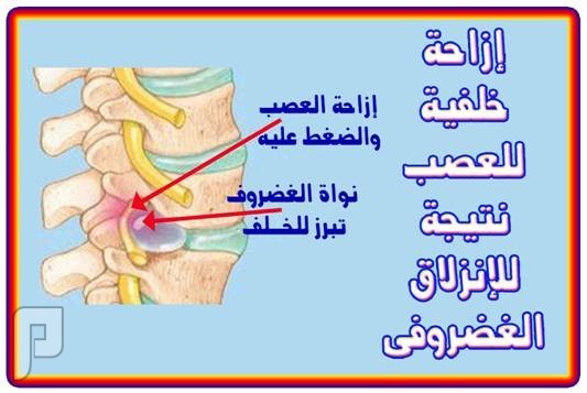 الانزلاق الغضروفي
