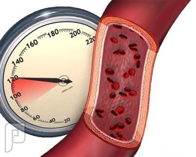 انخفاض ضغط الدم (أسباب وعلاج )