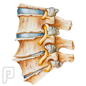 الفصال العظمي Lumbar Osteoarthritis -خشونة الفقرات القطنية