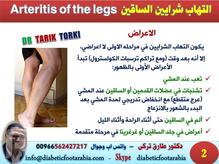 التهاب شرايين الساقين Arteritis of the legs | دكتور طارق تركى