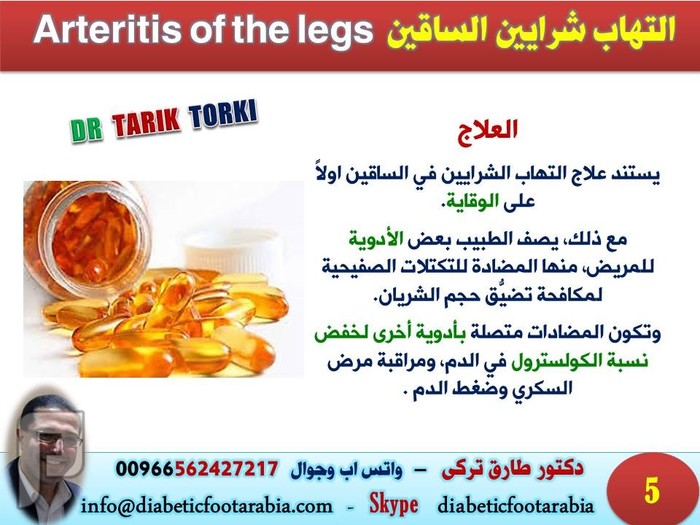 التهاب شرايين الساقين Arteritis of the legs | دكتور طارق تركى