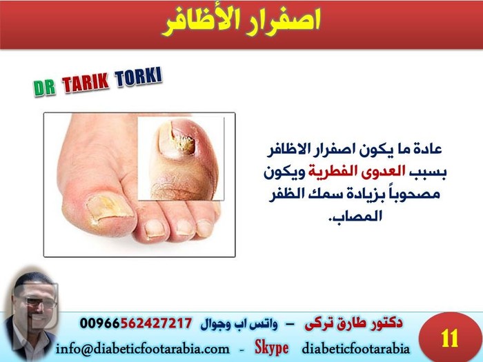 المشاكل الصحية التي تخبرك بها قدميك!! | دكتور طارق تركى
