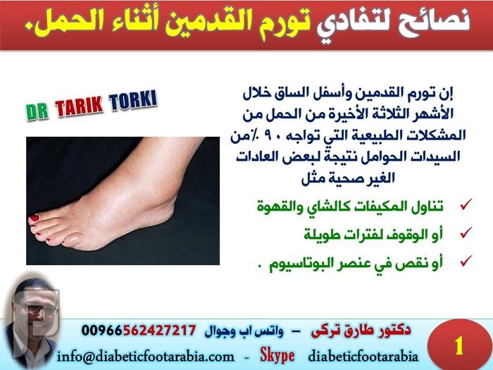 نصائح لتفادي تورم القدمين أثناء الحمل | دكتور طارق تركى