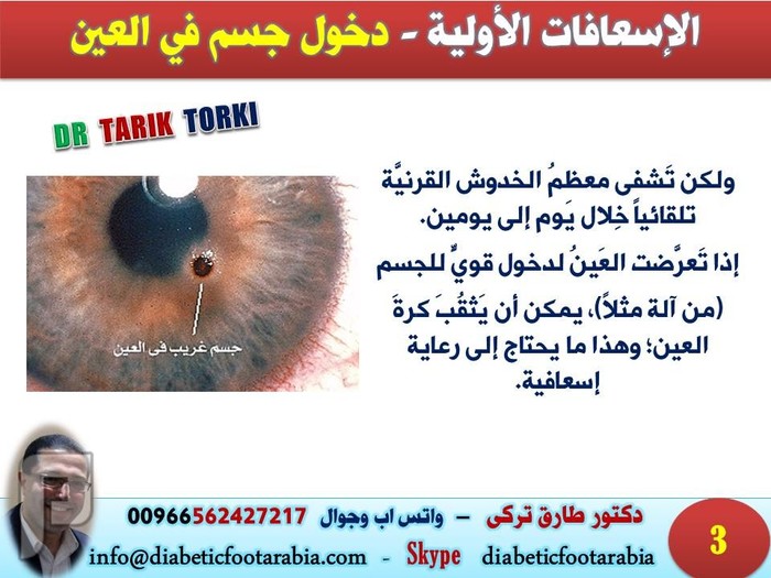 الإسعافات الأولية - دخول جسم في العين | دكتور طارق تركى