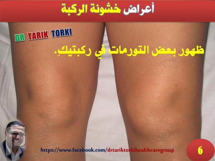 هل تعانى من خشونة الركبة - الاسباب و العلاج | دكتور طارق تركى