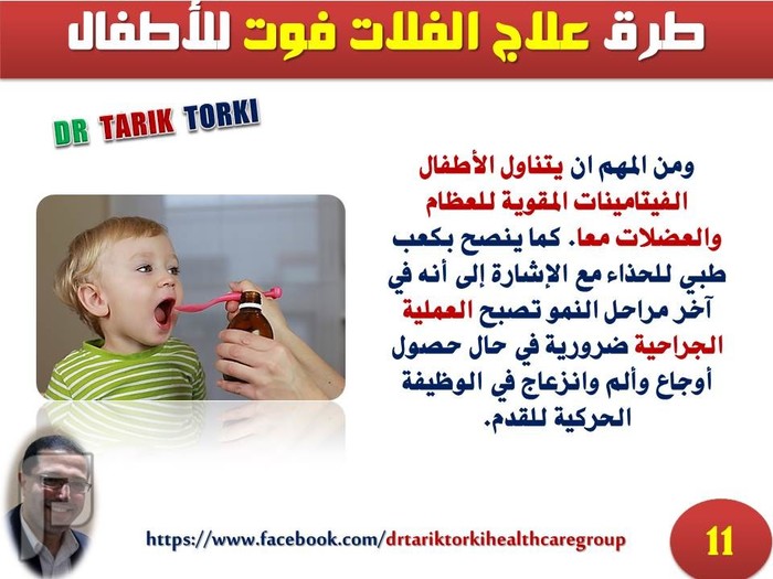 طرق علاج الفلات فوت للأطفال | دكتور طارق تركى
