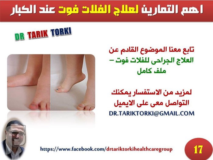 اهم التمارين لعلاج الفلات فوت عند الكبار | دكتور طارق تركى