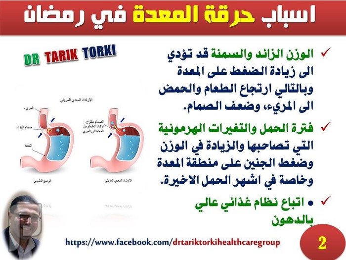 اسباب و علاج حرقة المعدة أثناء صيام رمضان | دكتور طارق تركى