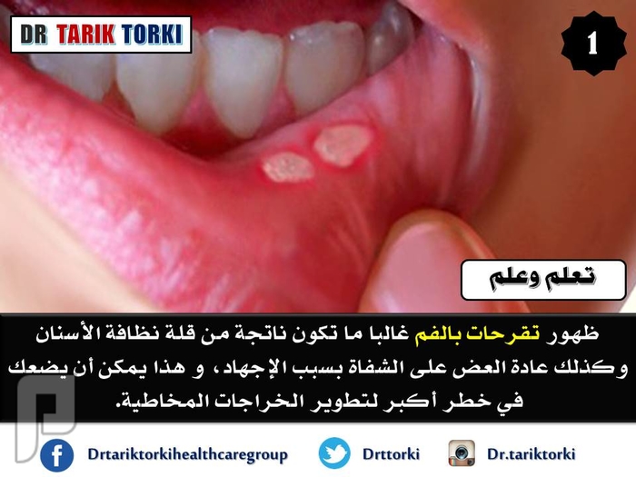 تعرف على 12 علاج منزلي للتخلص من تقرحات الفم | دكتور طارق تركى