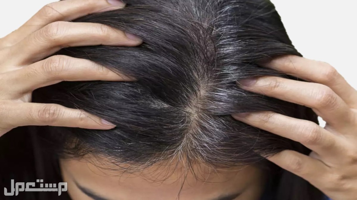 أسباب الشعر الأبيض عند الشباب وطرق العلاج الشعر الأبيض عند الشباب