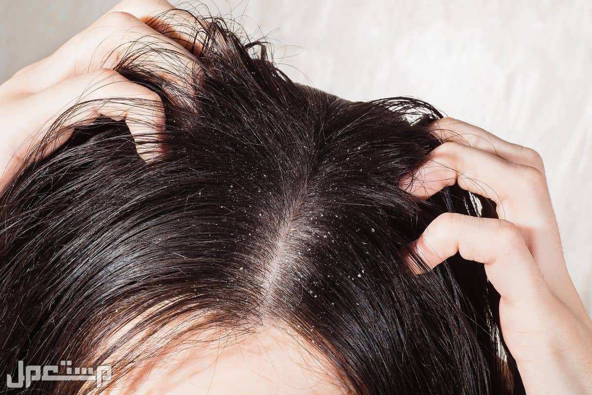 أسعار أفضل نوع شامبو للقمل في اليَمَن آثار القمل على الشعر