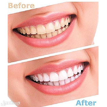 جهاز تبييض الأسنان الجديد من Luma Smile متوفر للطلب بكل المدن والتوصيل والشحن مجانا