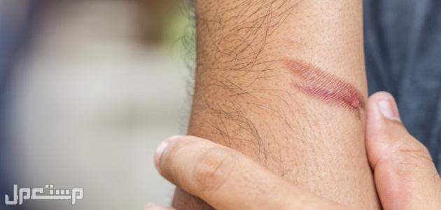 أفضل كريمات حروق الليزر ومواصفاتها واسعارها ازالة الشعر بالليز