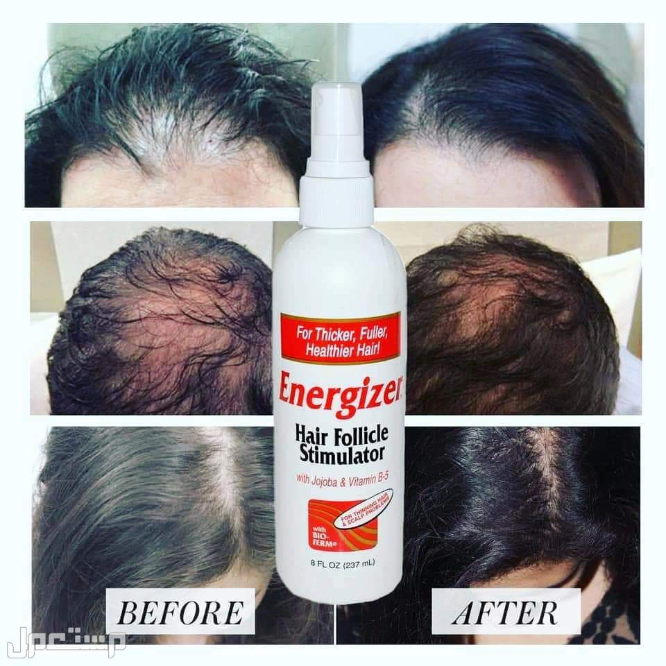 أفضل بخاخ لتكثيف الشعر قبل وبعد لاستخدام بخاخ energizer hair follicle stimulator