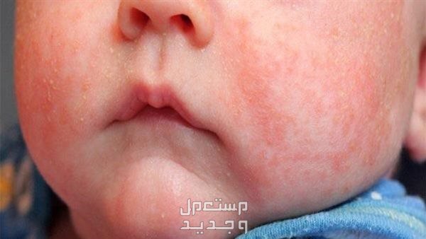 كريم لعلاج حمو النيل للكبار والصغار حمو النيل ع الوجه