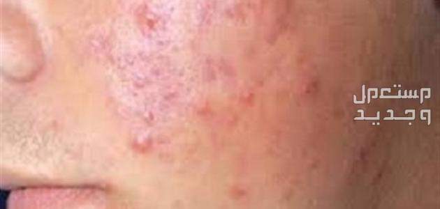 كريم لعلاج حمو النيل للكبار والصغار حمو نيل كبار