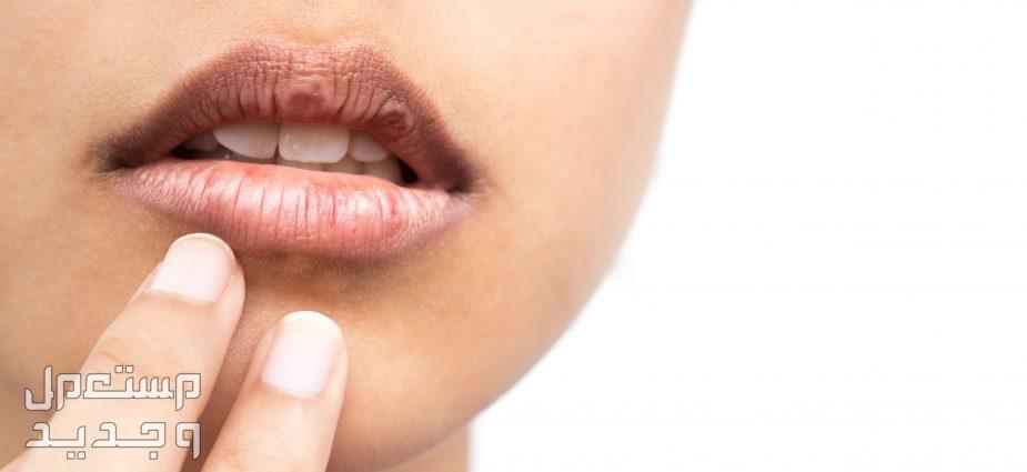 أفضل ماسك لتفتيح المناطق الداكنة حول الفم سواد الشفاق