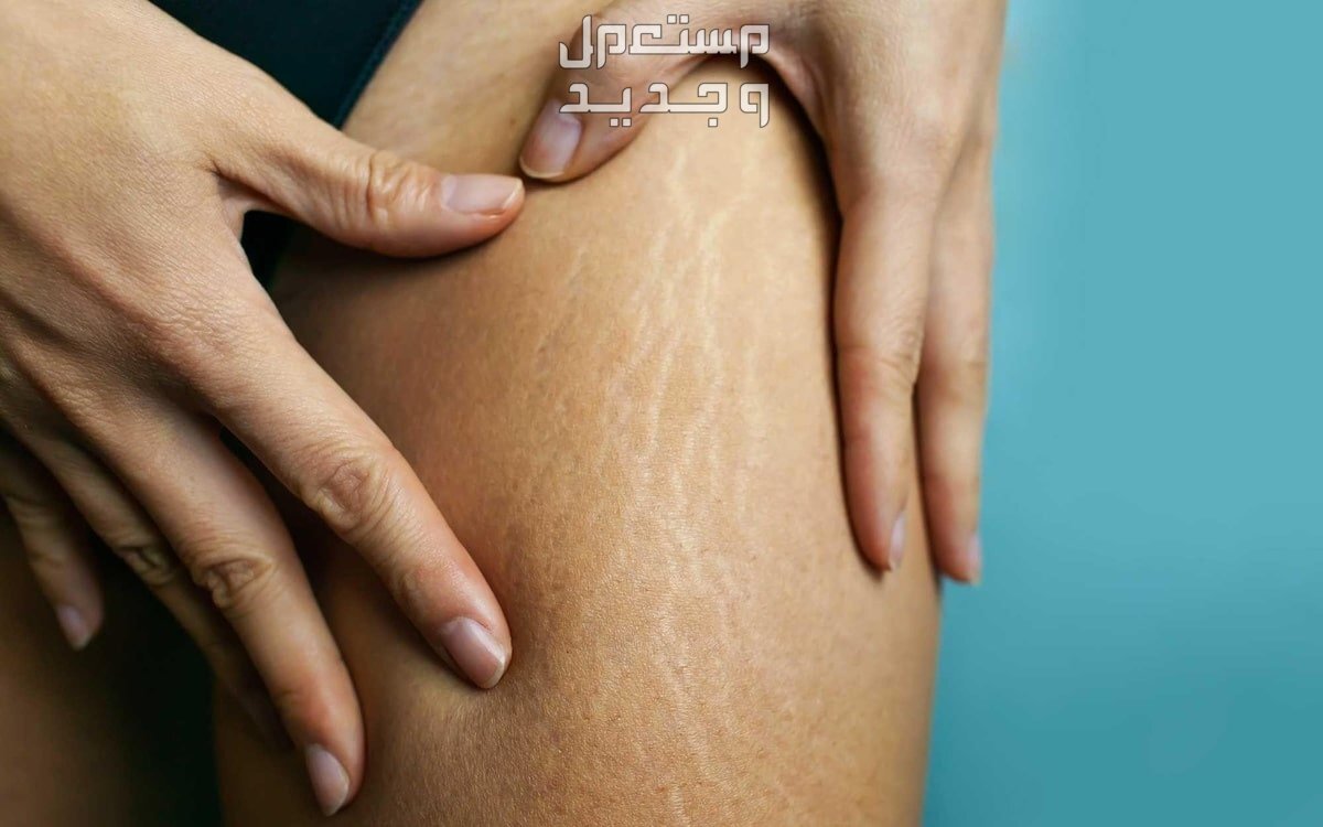 وصفات طبيعية للتخلص من السيلوليت شكل آخر للسيلوليت