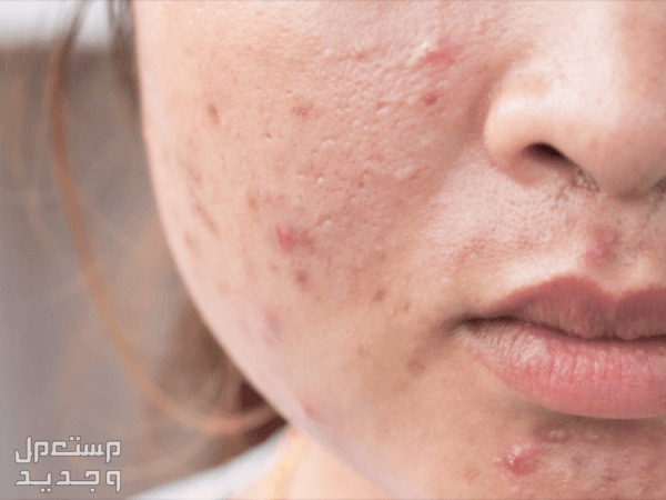 6 زيوت طبيعية لعلاج حبوب البشرة حبوب البشرة