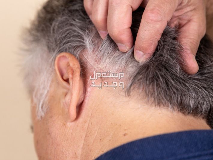 تعرف على أسباب اكزيما الشعر وطرق علاجها التهاب فروة الرأس