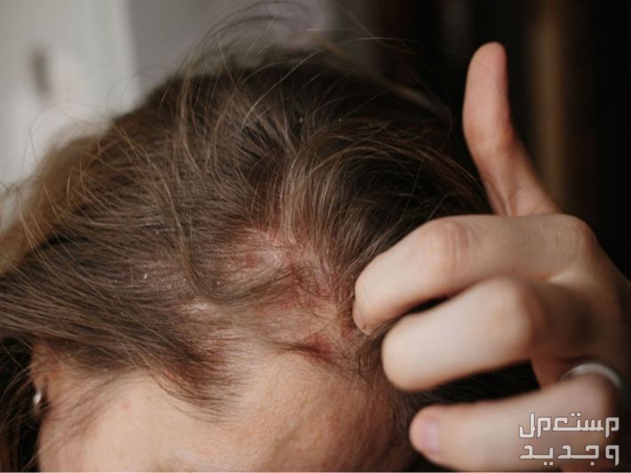 تعرف على أسباب اكزيما الشعر وطرق علاجها حكة الشعر
