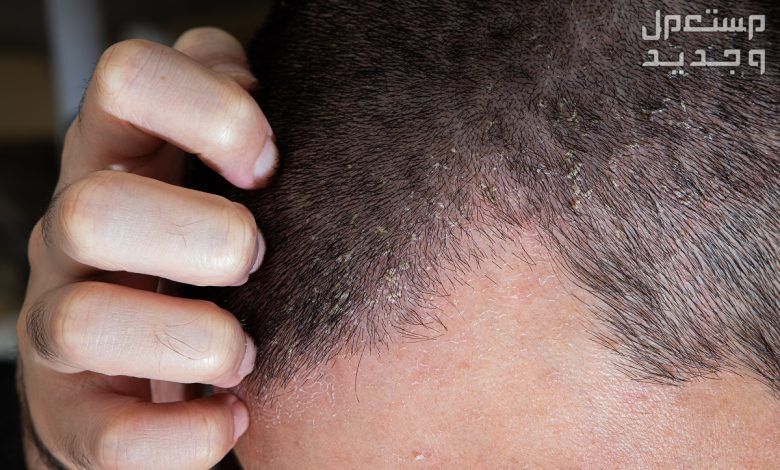 تعرف على أسباب اكزيما الشعر وطرق علاجها انتشار القشور في الشعر
