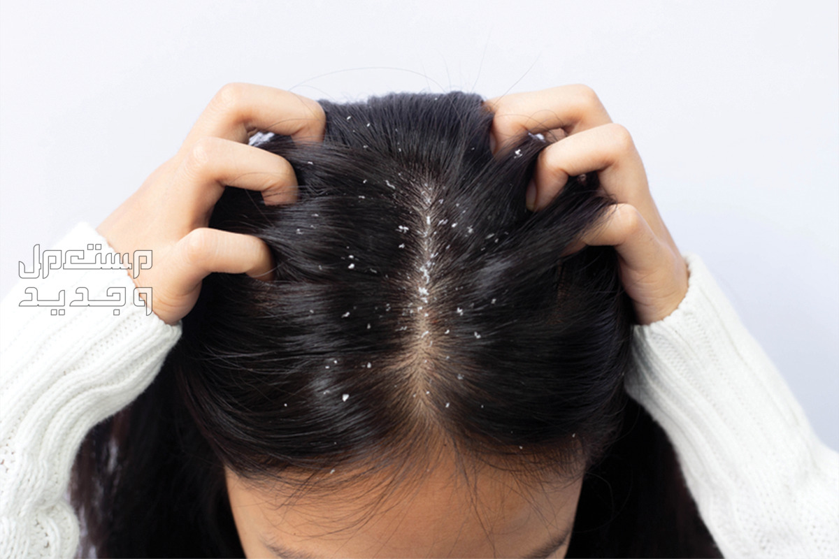 كيفية استخدام زيت القطران للشعر وفوائده في الجزائر قشرة الشعر