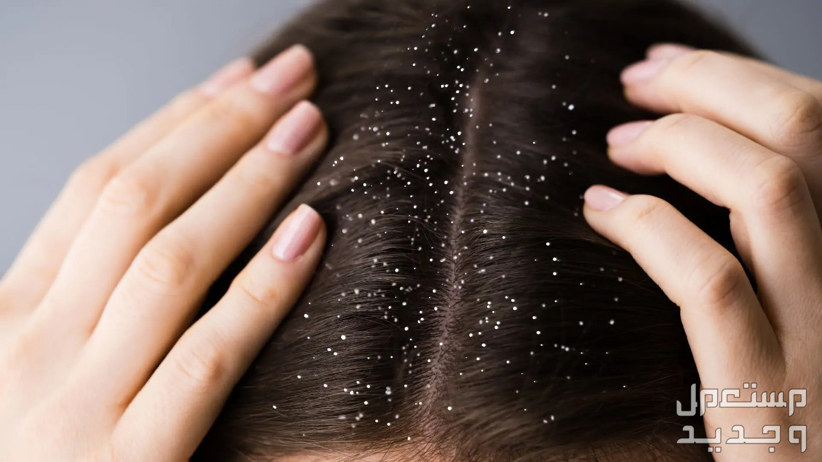 تعرف على كيفية استخدام زيت الزيتون للشعر مشكلة القشرة