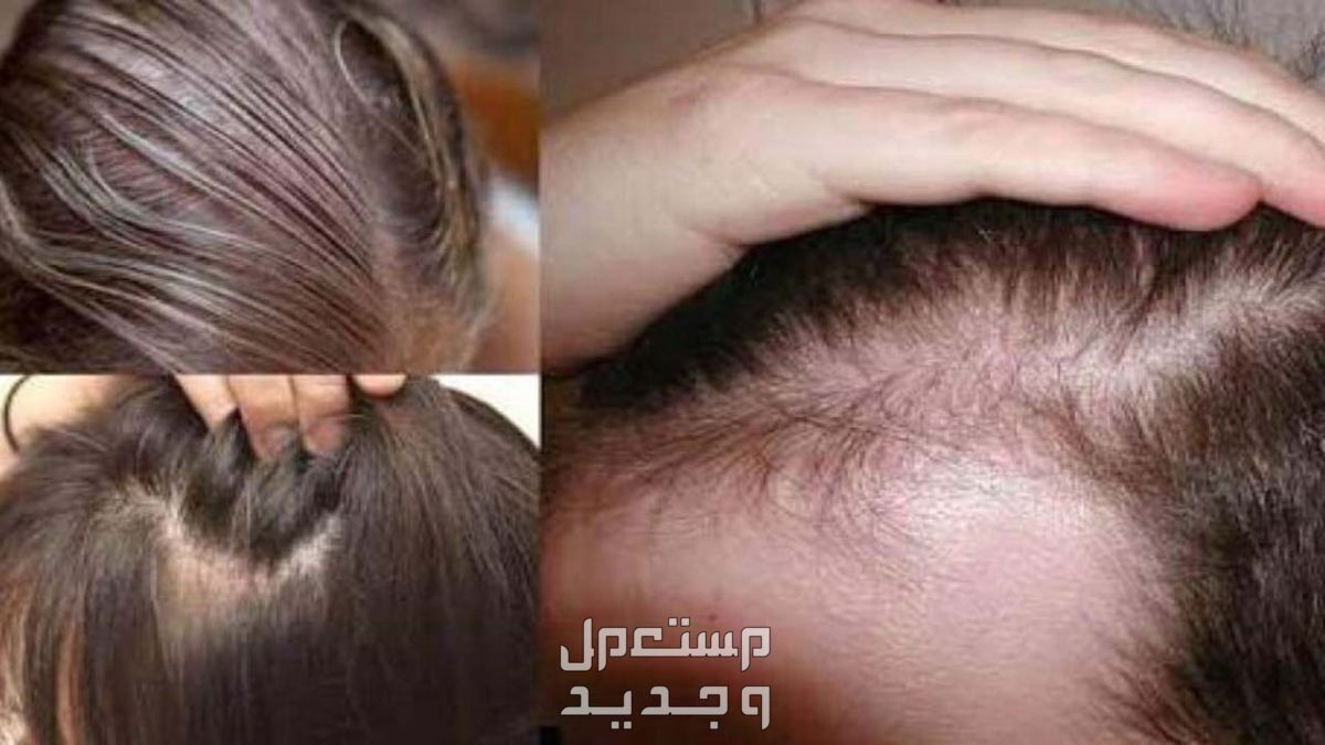 وصفة لتكثيف الشعر الخفيف وملء الفراغات في الأردن وصفة لتكثيف الشعر الخفيف وملء الفراغات