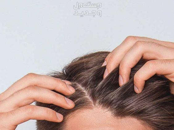 10 طرق لتنظيف فروة الرأس من القشرة والدهون في المغرب ترطيب فروة الرأس