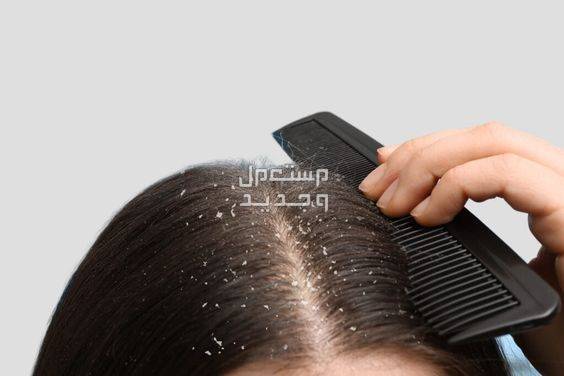 10 طرق لتنظيف فروة الرأس من القشرة والدهون في المغرب تحسين فروة الرأس