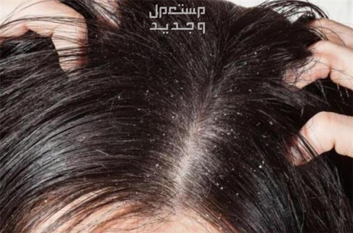 10 طرق لتنظيف فروة الرأس من القشرة والدهون قشر الرأس