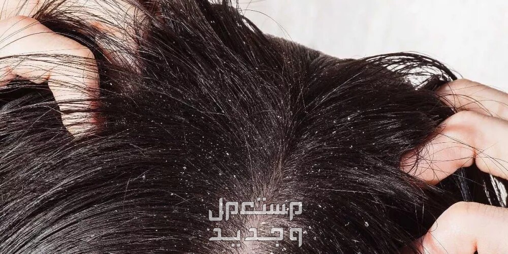 أفضل علاج للقشرة مجرب أفضل علاج للقشرة مجرب