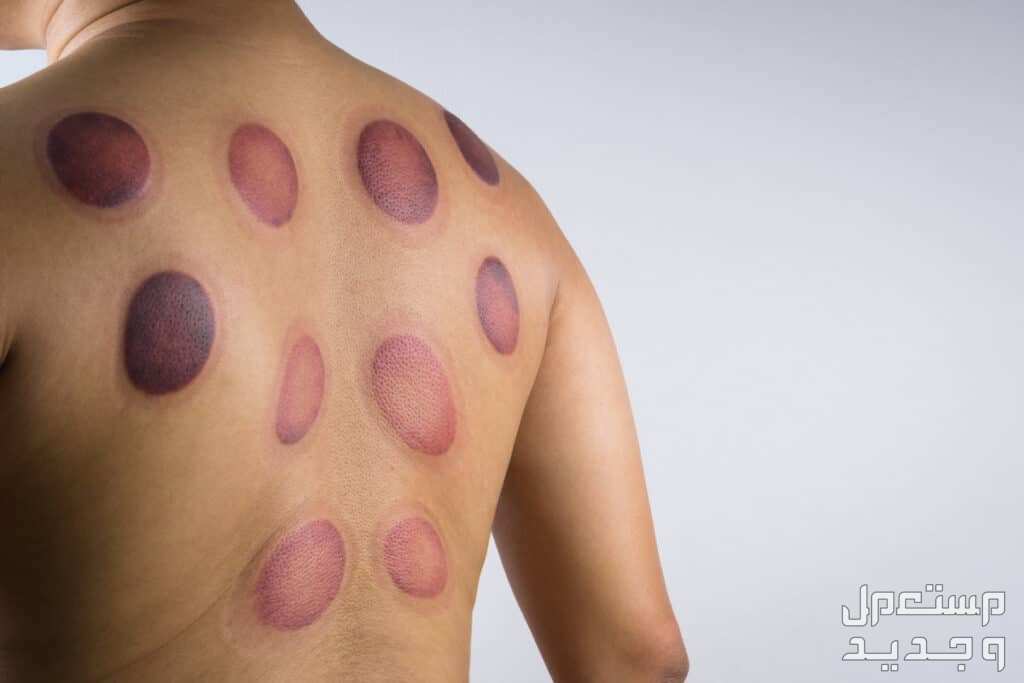 أفضل كريم لإزالة آثار الحجامة.. دليل شامل للعناية بالبشرة اثار الحجامة على الظهر