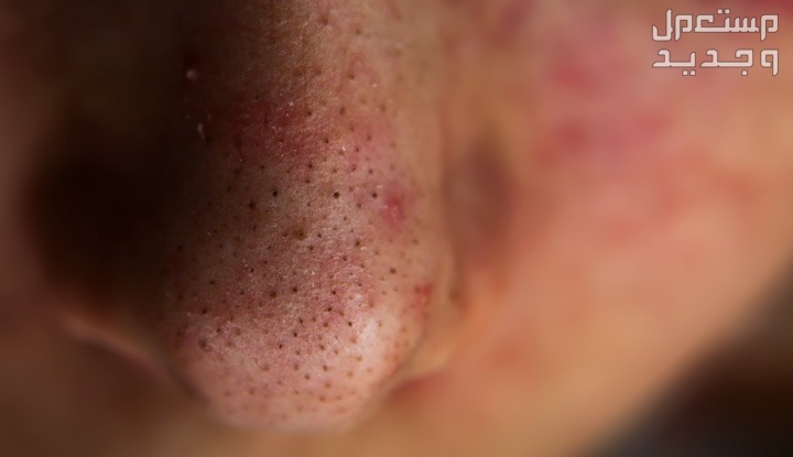 أفضل 7 منتجات تنظيف البشرة من الرؤوس السوداء رؤوس سوداء