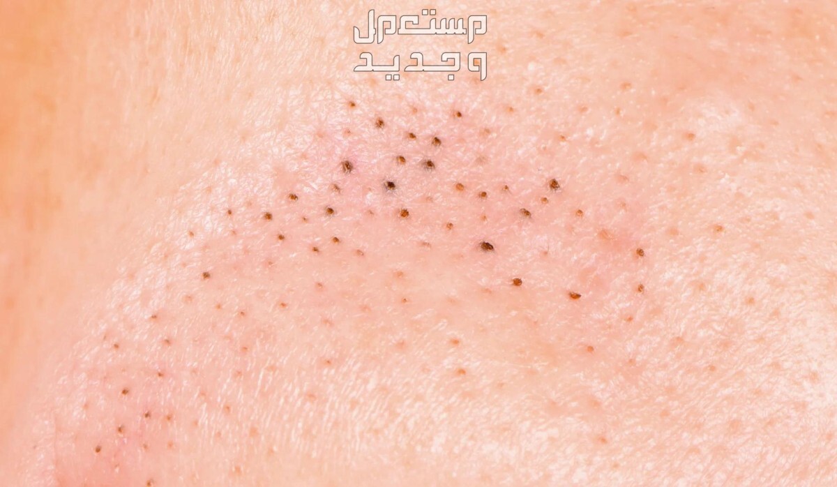 أفضل 7 منتجات تنظيف البشرة من الرؤوس السوداء رؤوس سوداء