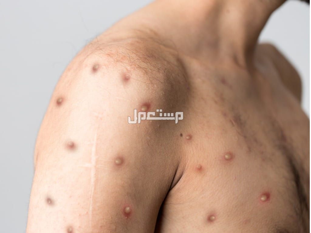 هل جدري القرود خطير؟ تعرف على الأعراض وطرق الانتقال والتشخيص والعلاج رجل مصاب بطفح جلدي وجدري القرود