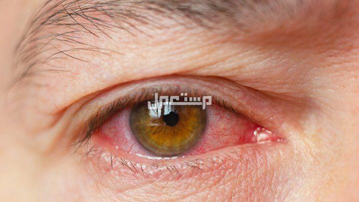 أفضل قطرة لعلاج جفاف العين لعام 2024 اعراض جفاف العين
