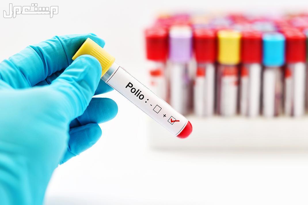 5 حقائق عن شلل الأطفال وطرق انتقاله وعلاجه تطعيم شلل الاطفال