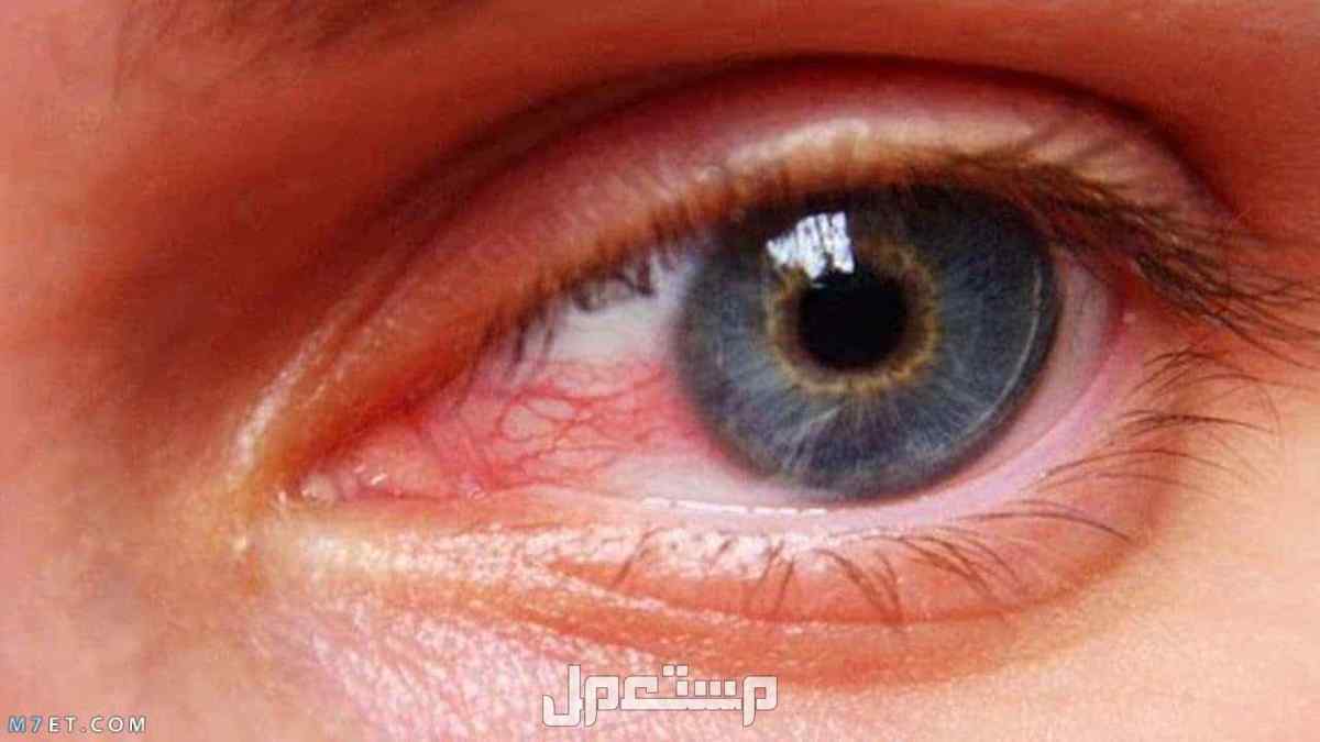 ما هو تفسير حلم العيون الحمراء في المنام لابن سيرين؟ تفسير حلم العيون الحمراء في المنام