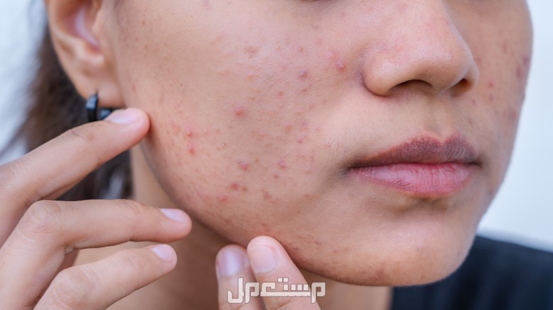 10 فوائد لقشور الموز بالصور.. تعرف عليها وجه فتاة ممتلىء بحبوب الشباب