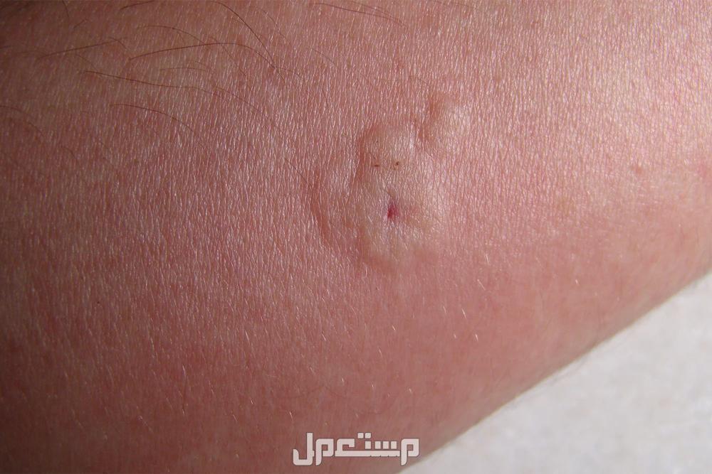 كل ما تريد معرفته عن سم النحل .. الفوائد والآثار الجانبية لسعة النحل