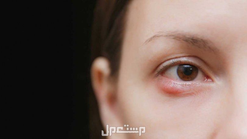 طرق طبيعية للتخلص من انتفاخ العين بعد البكاء أفضل علاج منزلي لانتفاخ العيون