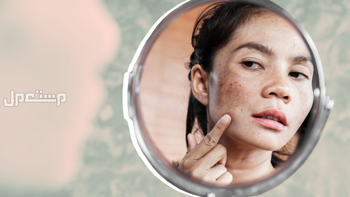 طرق التخلص من تصبغات الوجه طبيعياً طرق التخلص من تصبغات الوجه