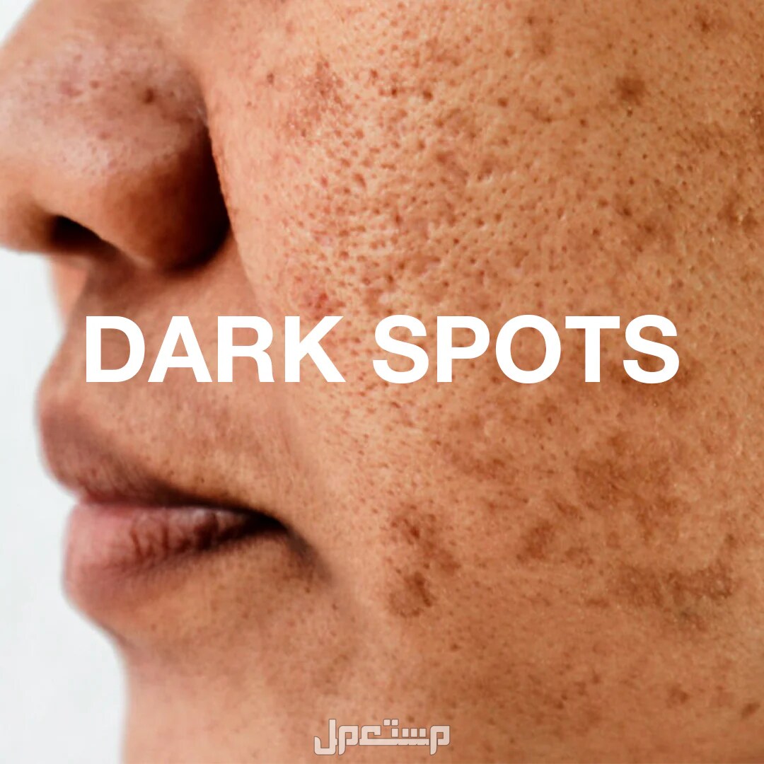 طرق التخلص من تصبغات الوجه طبيعياً تجربتي مع تصبغات الوجه