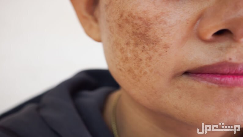 طرق التخلص من تصبغات الوجه طبيعياً هل تزول تصبغات الوجه؟