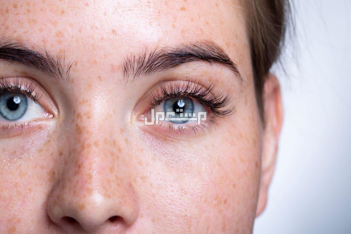 أسباب ظهور النمش المفاجئ النمش لمفاجيء وعلاجه